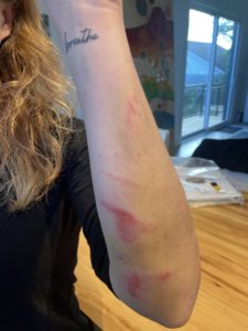 Hannah P shows her scraped arm after crashing her mountain bike